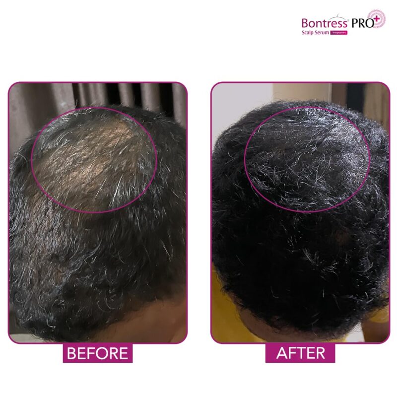 Bontress PRO+ Scalp Serum Fortified with 3% Redensyl, 3% Anagain, 4% Capixyl, 3% Procapil | Hair Serum for Hair Growth & Hair Fall 60ml - Image 6