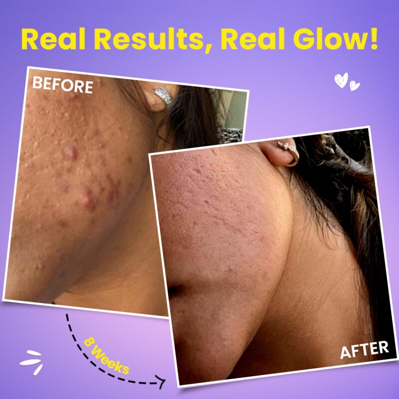 Chicnutrix Glow- 20 Effervescent Tablets| Japanese Glutathione & Vit. C| Antioxidants for clear, glowing skin| Sugar-free, Strawberry-lemon flavour - Image 4